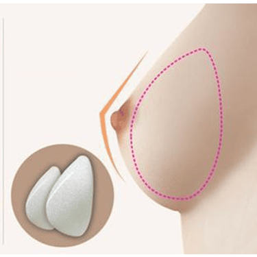 teardrop implant